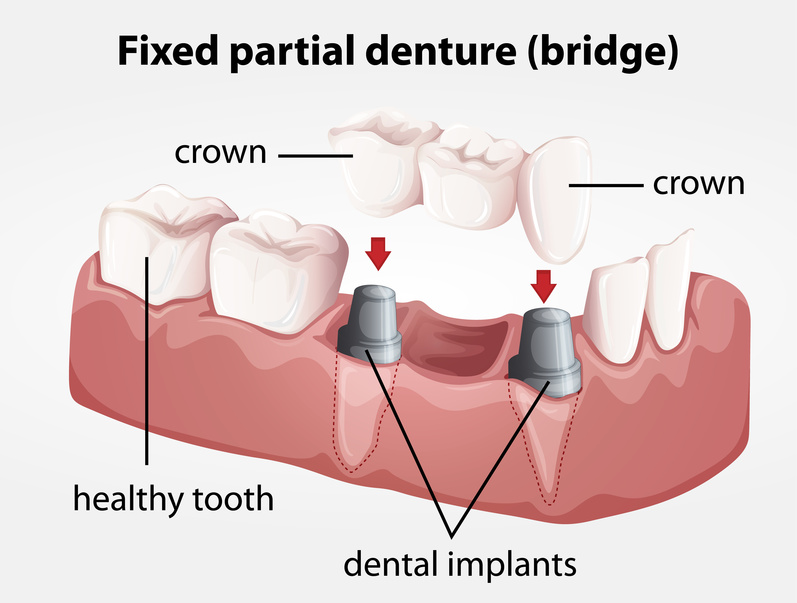 Bone grafting Los Angeles