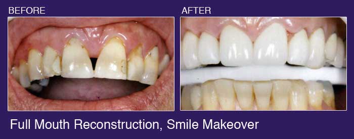 teeth whitening before and after tarzana