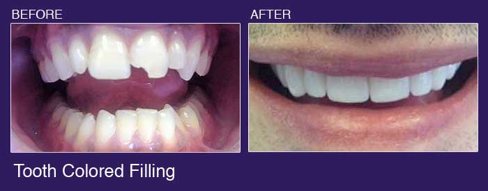 porcelain veneers before and after