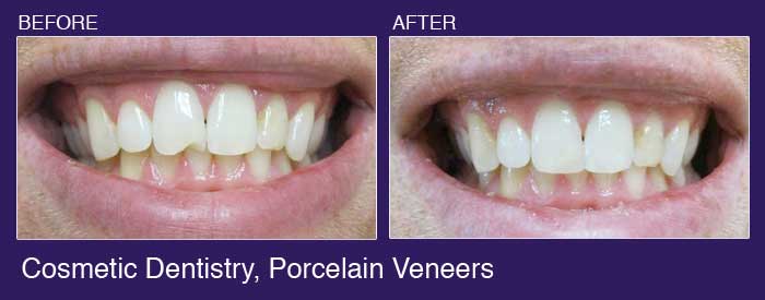 cosmetic dentistry before and after
