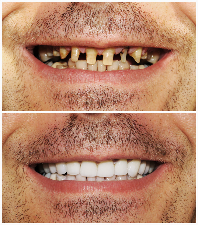 Dental Procedures Before and After - Tarzana Dentist ...