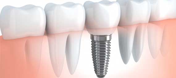 implant dentist reseda