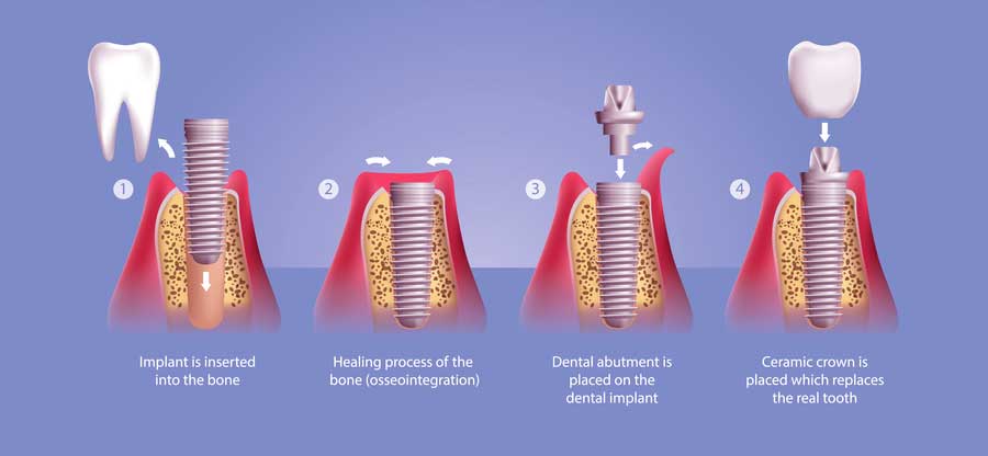 tarzana dental implants  
