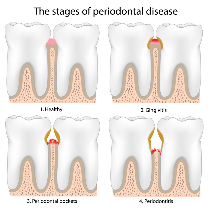 Periodontal Disease treatment Los Angeles
