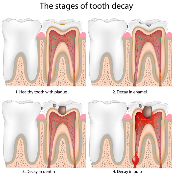 root canal stages