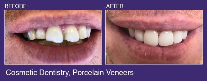 tarzana porcelain veneers