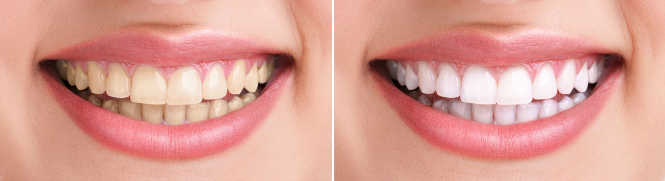 Teeth whitenning tips